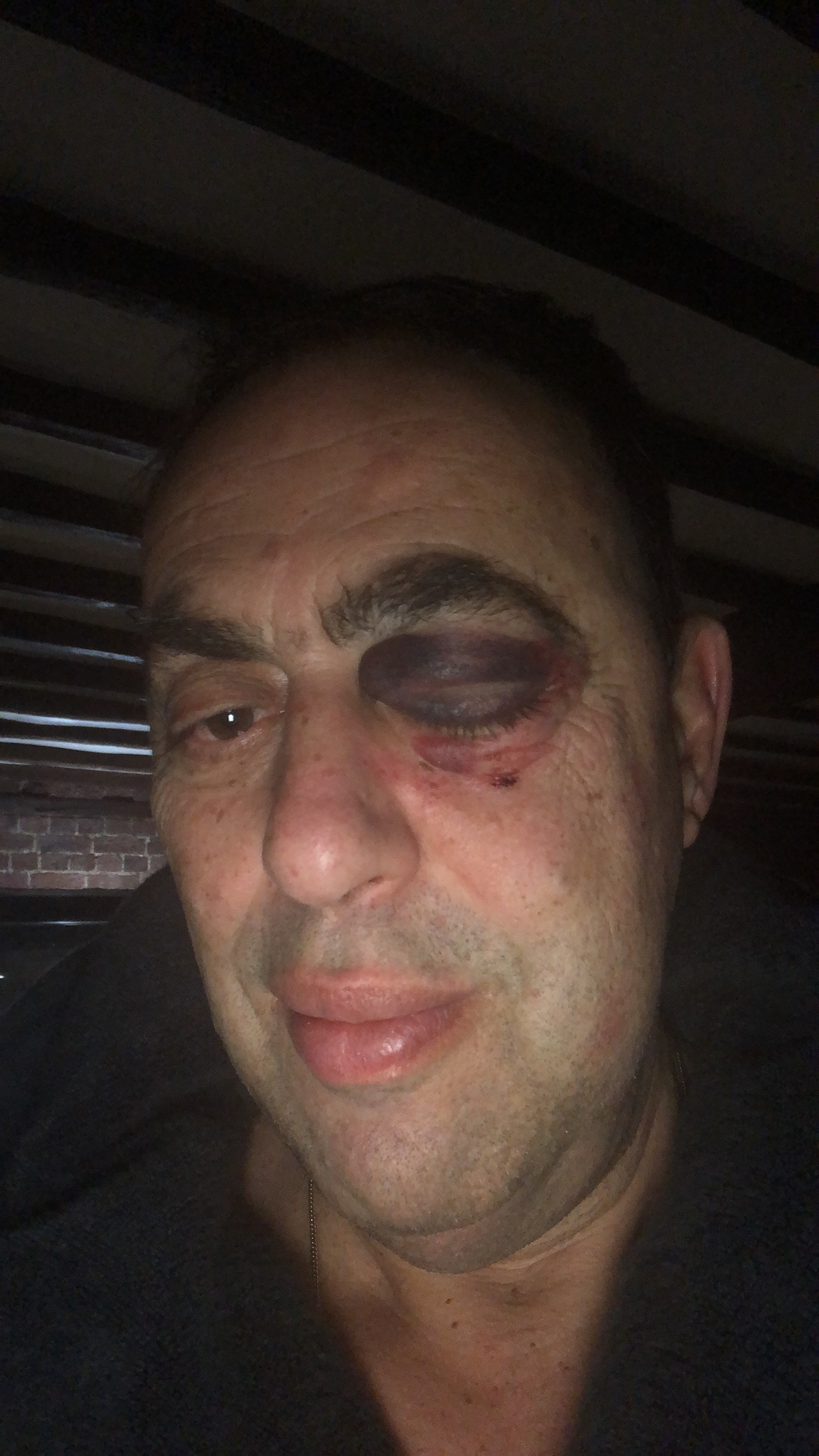 Colin was left with a fracture by the cheekbone and a severely bruised eye