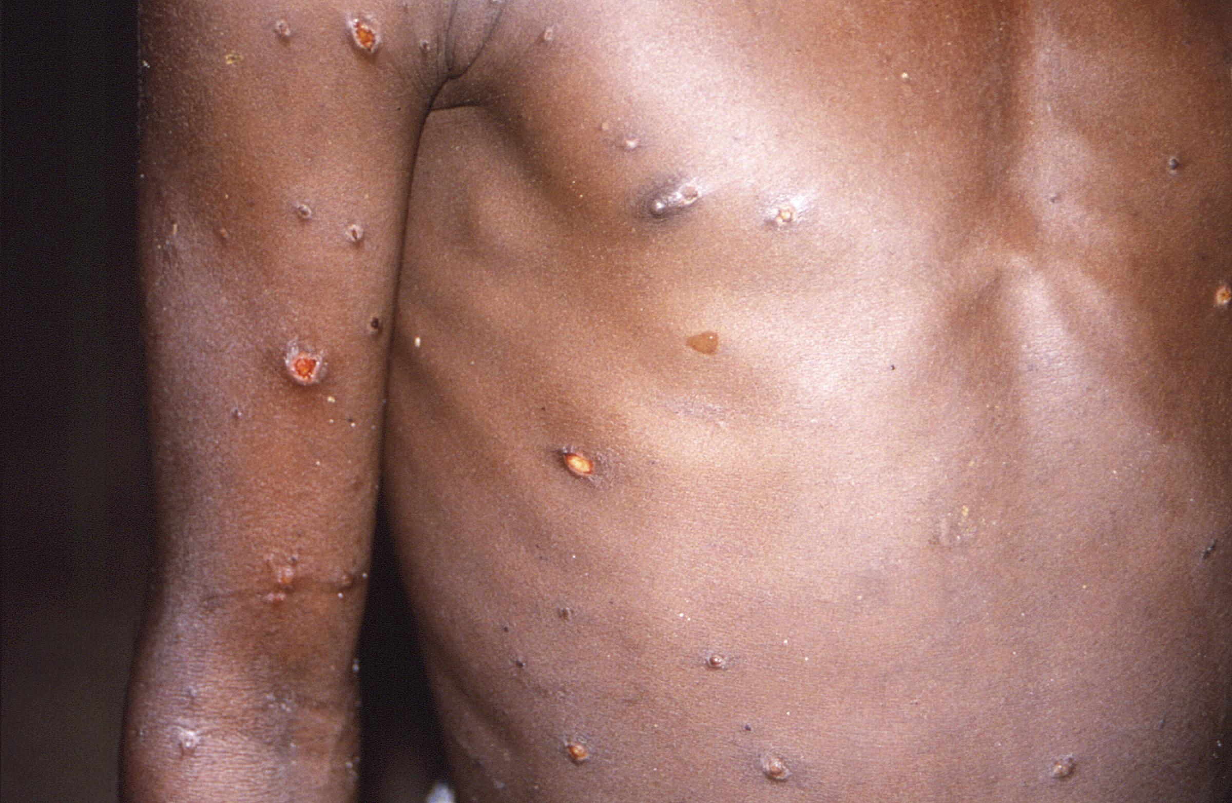 Infection par le virus Monkeypox UK : Voir tous les avertissements sanitaires à ce jour